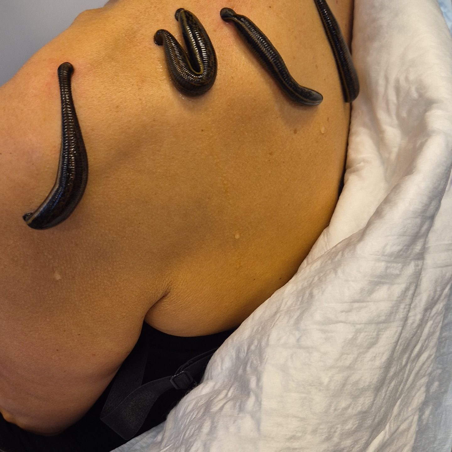 Bloedzuigertherapie / hirudotherapie